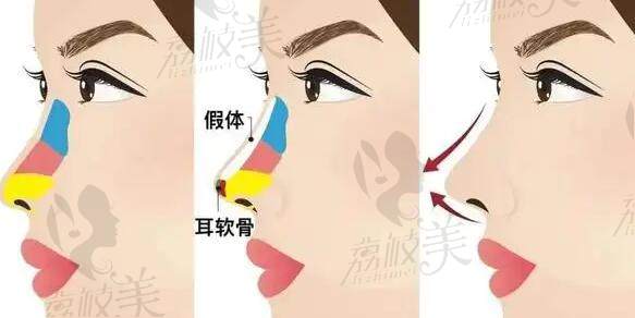 無錫施爾美姚義超做鼻子怎么樣