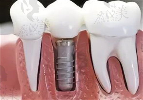 东莞莞口口腔医院收费标准