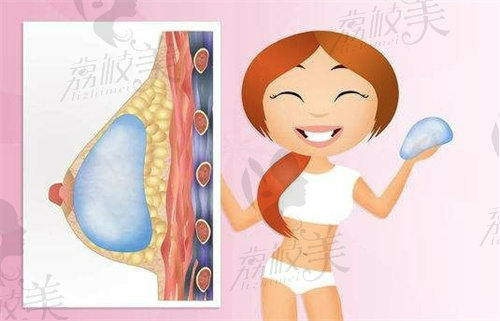 深圳雅涵邹永红隆胸技术优势