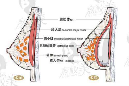 深圳雅涵邹永红做内窥镜丰胸怎么样