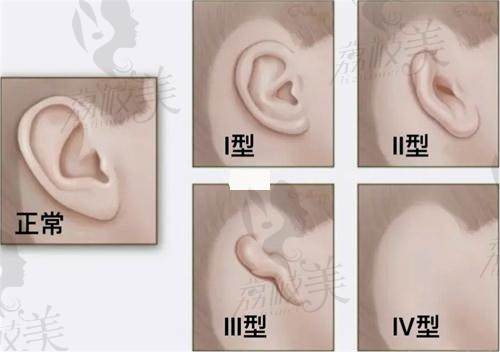 上海海華李營(yíng)醫(yī)生做耳再造手術(shù)怎么樣