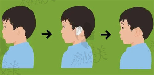 上海海華李營(yíng)醫(yī)生做耳再造