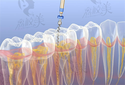 前牙根管治疗和后牙根管治疗的区别