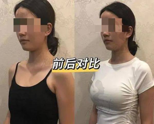 唐新輝醫(yī)生做隆胸好嗎