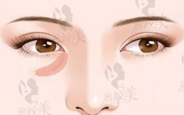 弗缦胶原蛋白打泪沟好吗