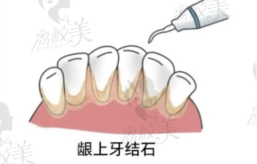 昆明竹子口腔做龈下刮治好吗