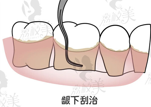 龈下刮治适宜人群