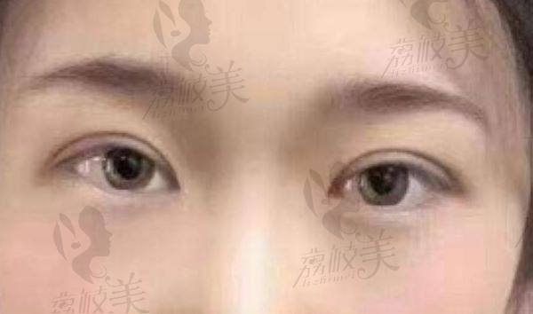 北京画美张守玲做双眼皮怎么样