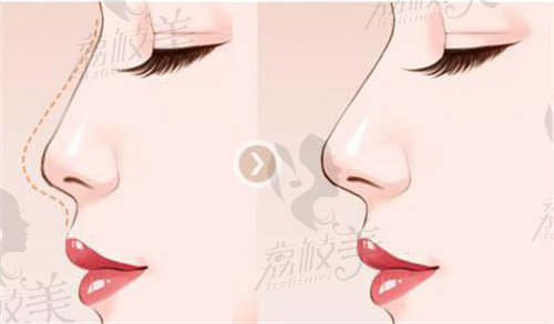 長沙蔣帝時(shí)手術(shù)怎么樣