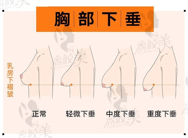孙家明隆胸
