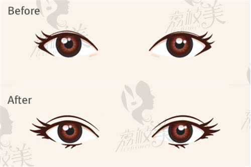 王恒醫(yī)生內眼角修復技術怎么樣