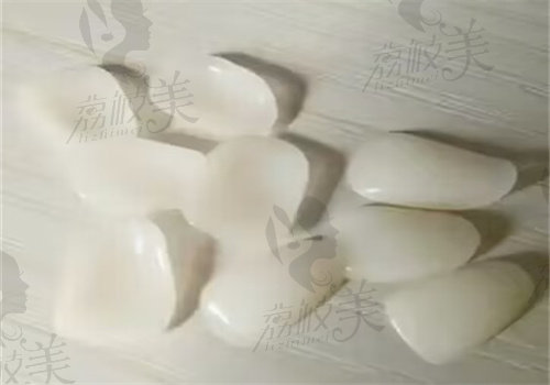 惠州致美口腔羅剛做樹脂貼面（6顆）多少錢