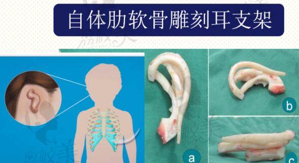 埋线精灵耳是怎么操作的