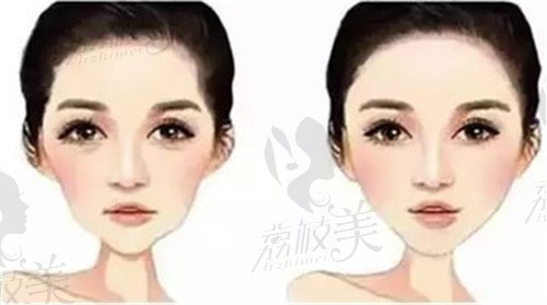 上海海華韋敏做自體脂肪填充