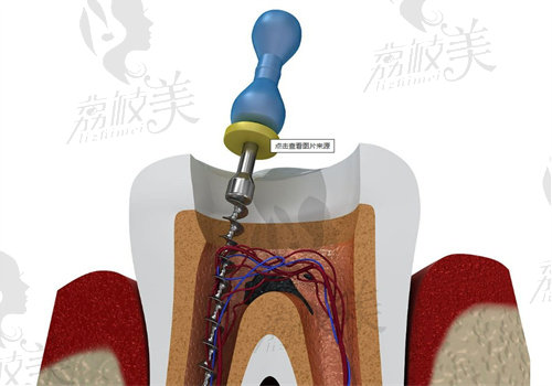 长春嘉盛口腔医院做根管治疗怎么样