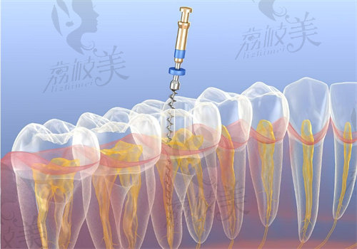 长春嘉盛口腔医院做根管治疗怎么样