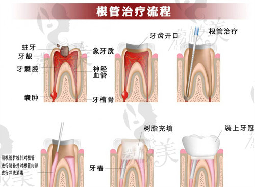 杭州英博口腔潘超杰做后磨牙根管治療