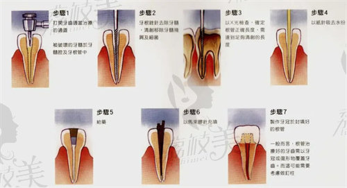杭州英博口腔潘超杰做后磨牙根管治療多少錢(qián)
