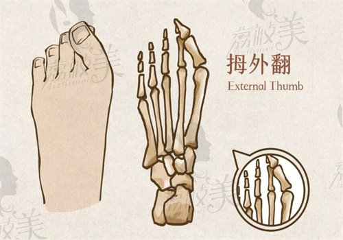 马桂文大脚骨手术修复过程情况