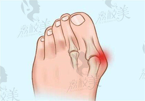 马桂文大脚骨手术30分钟矫正