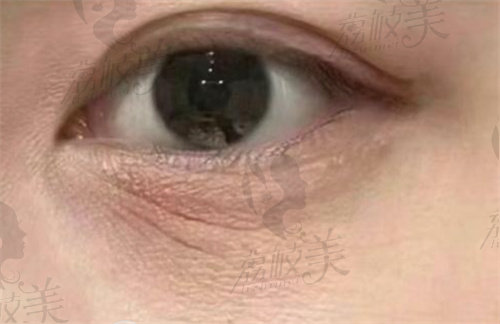 上海海華安洪賓做眼周年輕化