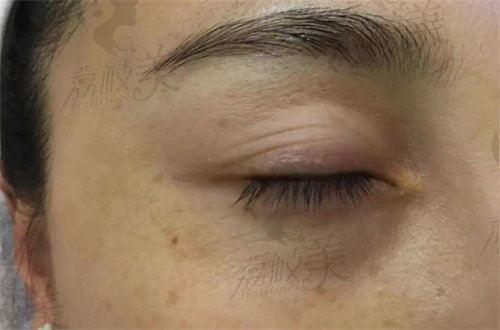 上海海華安洪賓做眼周年輕化