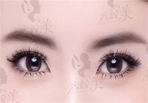 闫品行做双眼皮技术怎么样