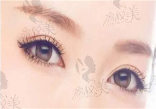 闫品行做双眼皮技术怎么样
