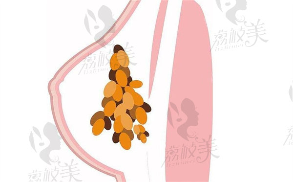 胸部奥美定异物取出