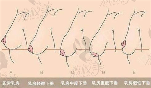 重庆华美陈德法做胸部韧带提升