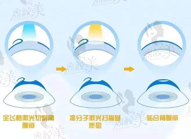 寧波愛爾眼科醫(yī)院近視眼手術收費標準