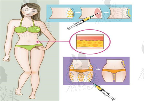 张让虎腰腹环吸实例