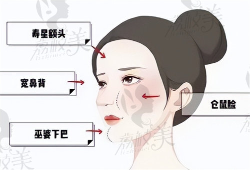 廣州煥新顏金洪堯醫(yī)生做饅化臉修復