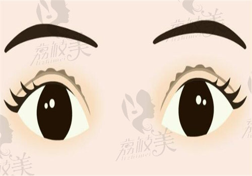長沙張姣姣雙眼皮修復(fù)無投訴
