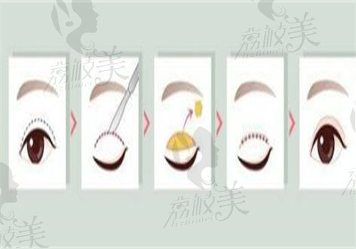 長沙張姣姣雙眼皮修復(fù)無黑料