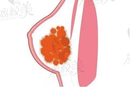 國內(nèi)自身脂肪豐胸哪個醫(yī)生好