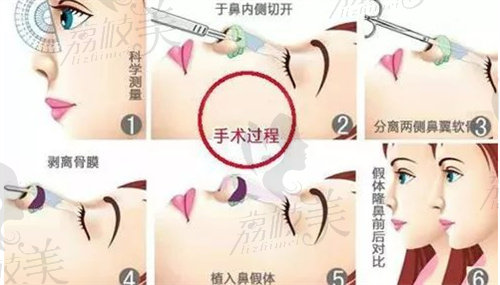 杭州項昌峰做鼻子怎么樣