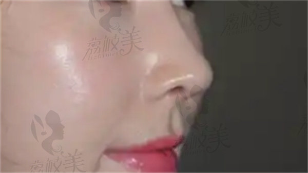 初次隆鼻手术