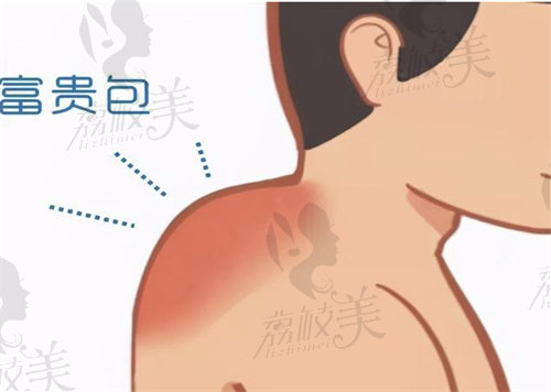 李方伟富贵包治疗