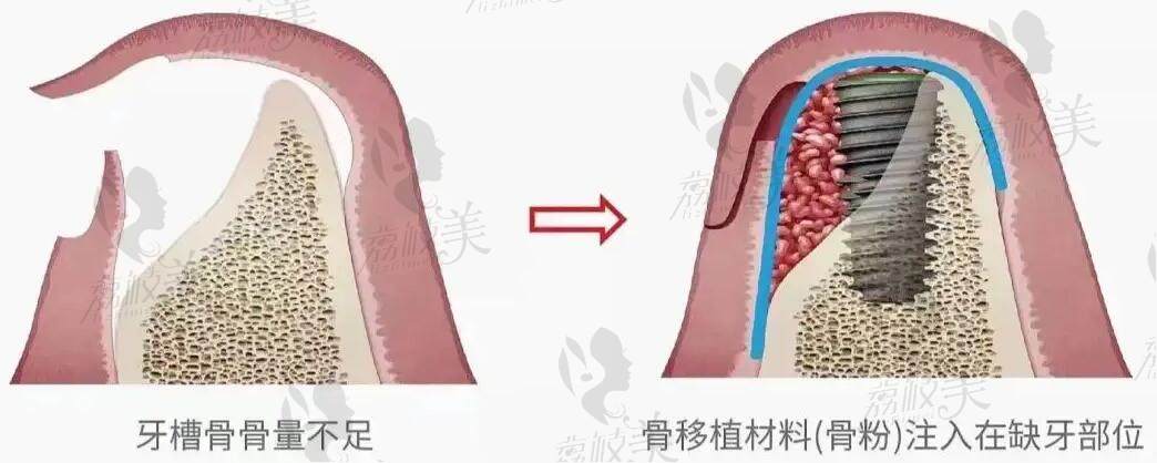 国内种植牙价格一览表