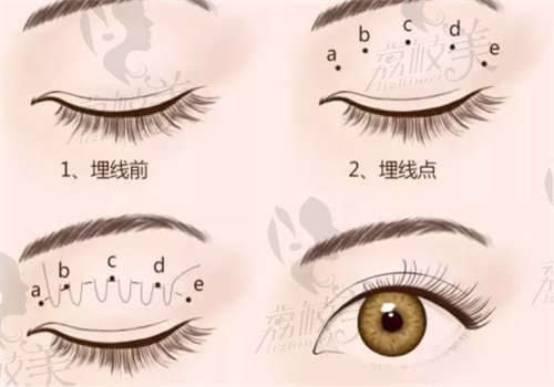 常冬青修复双眼皮怎么样