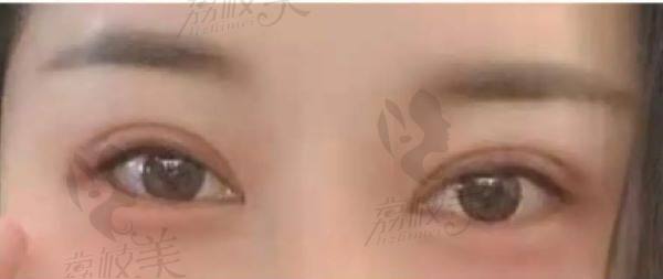 找杜园园做眼修复几天后的我