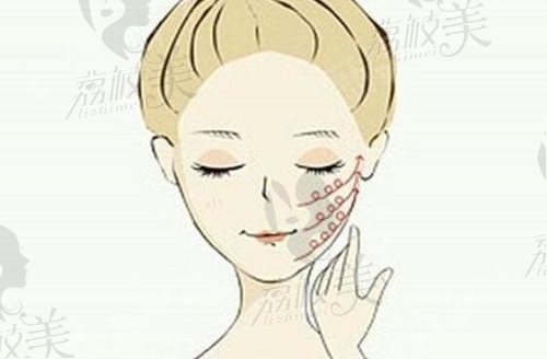 成都軍大面部吸脂怎么樣？