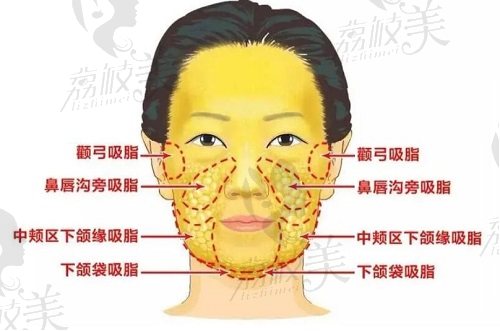成都軍大面部吸脂怎么樣？