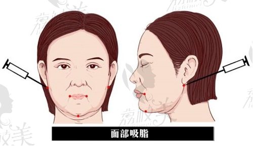 成都軍大面部吸脂怎么樣？