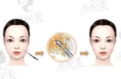 成都軍大面部吸脂怎么樣？
