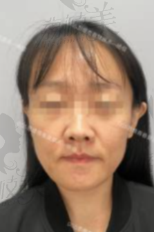 北京杨俊拉皮手术优势