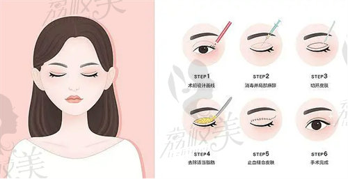 何文星做双眼皮修复多少钱