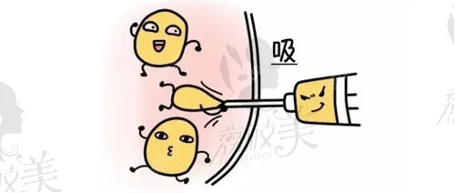 張讓虎醫(yī)生吸脂