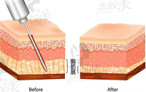 張讓虎醫(yī)生吸脂